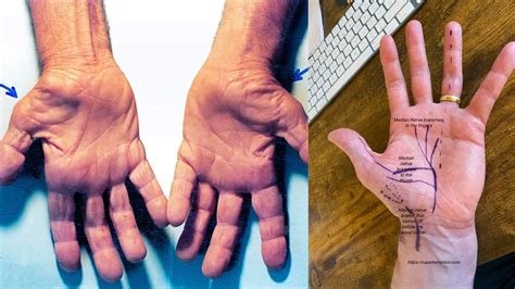 आईटी प्रोफेशनल्स (IT Professionals) में कार्पल टनल (Carpal Tunnel) सिंड्रोम की रोकथाम