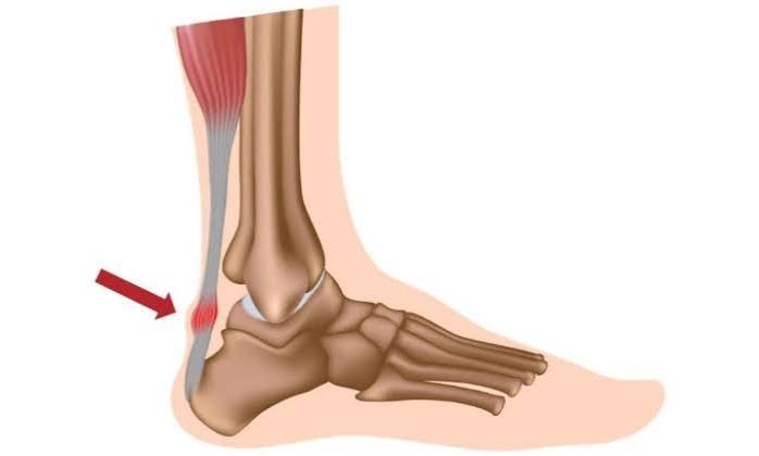 एच्लीस टेंडिनोपैथी (Achilles Tendinopathy): एड़ी के पीछे के दर्द का एक्सेंट्रिक लोडिंग इलाज