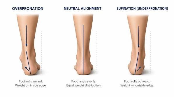 ओवरप्रोनेशन (Overpronation) और सुपिनेशन (Supination) वाले पैरों की पहचान कैसे करें?