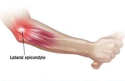 गोल्फर एल्बो (Golfer's Elbow) और टेनिस एल्बो के बीच का अंतर और क्लिनिकल उपचार