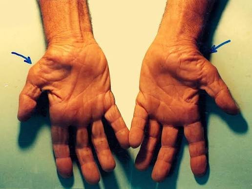 ग्राफिक डिज़ाइनर्स और कोडर्स के लिए कार्पल टनल सिंड्रोम (Carpal Tunnel) से बचाव