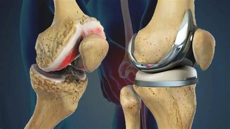 घुटने के नी-कैप (Patella) को सुरक्षित रखने वाले वीएमओ (VMO) आइसोमेट्रिक व्यायाम