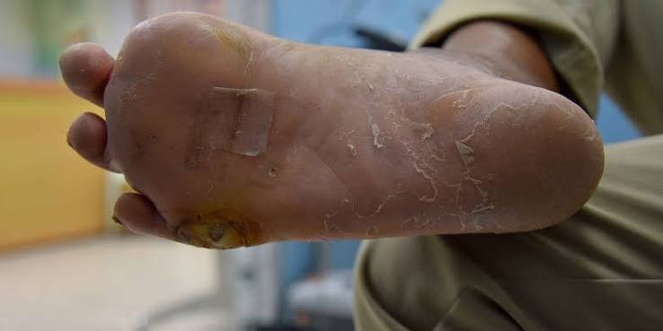 डायबिटिक फुट (Diabetic Foot) की देखभाल: सही जूतों और मोजों का चुनाव