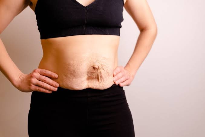 डायस्टेसिस रेक्टी (Diastasis Recti): डिलीवरी के बाद पेट की मांसपेशियों का अलग होना