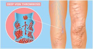 डीप वेन थ्रोम्बोसिस (DVT) की रोकथाम के लिए पोस्ट-ऑपरेटिव व्यायाम