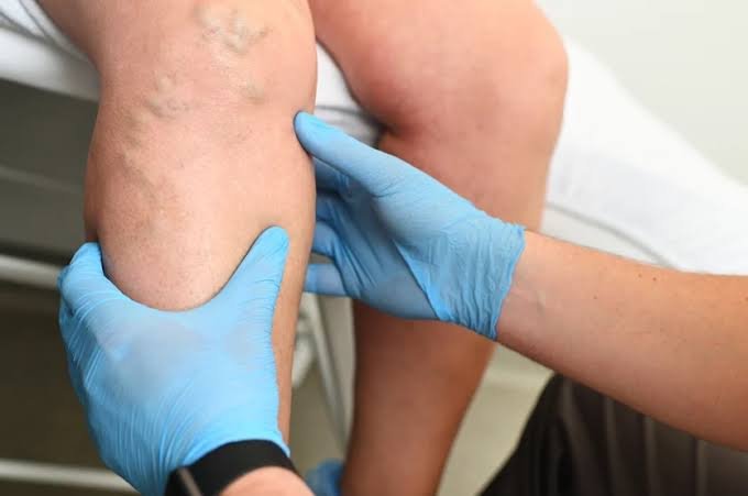 डीप वेन थ्रोम्बोसिस (DVT) से बचाव के लिए पोस्ट-सर्जरी लेग पंपिंग एक्सरसाइज