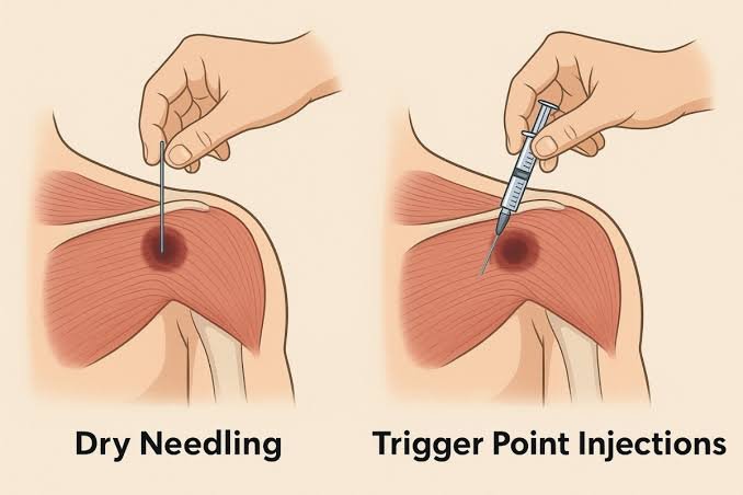 ड्राई नीडलिंग (Dry Needling) और ट्रिगर पॉइंट थेरेपी का वैज्ञानिक महत्व
