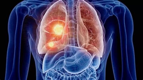 फेफड़ों (Lungs) की क्षमता बढ़ाने के लिए डायफ्रामिक ब्रीदिंग का डेमो