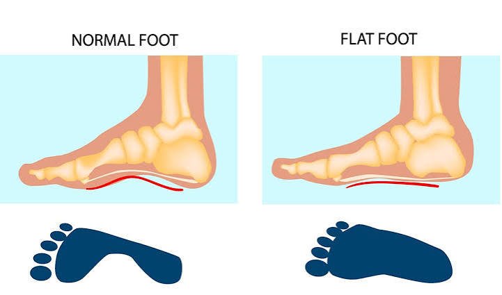फ्लैट फुट (Flat Feet) और शरीर के स्ट्रक्चरल अलाइनमेंट (Alignment) का संबंध