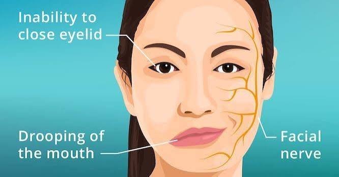 बेल्स पाल्सी (Bell's Palsy) के लिए फेशियल पीएनएफ (PNF) तकनीक