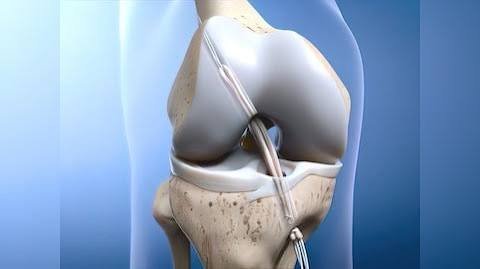 लिगामेंट इंजरी (ACL Tear) के बाद रिकवरी तेज करने के लिए कोलेजन युक्त आहार