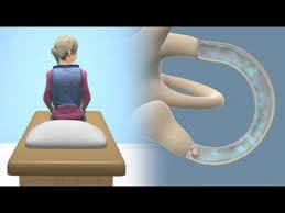 वर्टिगो (BPPV) के चक्कर रोकने के लिए क्लिनिकल एपली मैन्युवर (Epley Maneuver)