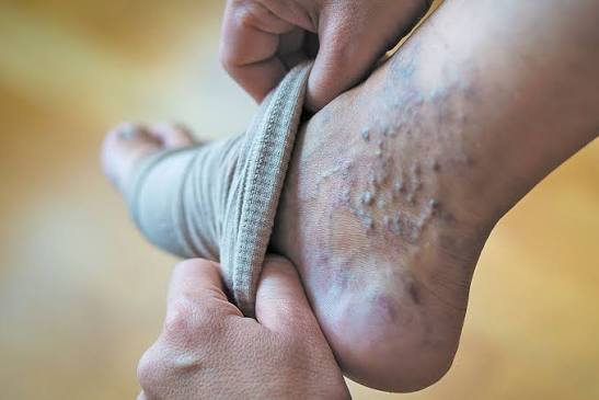 वेरिकोज वेन्स (Varicose Veins) के दर्द को कम करने के लिए पैरों के विशेष व्यायाम
