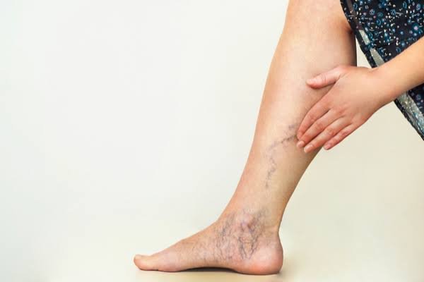 सीनियर सिटिजन्स में वेरिकोज वेन्स (Varicose Veins) का दर्द कैसे कम करें?