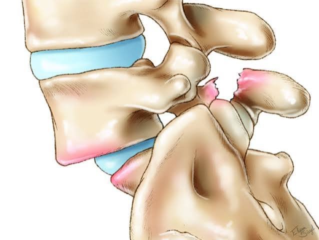 स्पॉन्डिलोलिस्थीसिस (Spondylolisthesis) के लिए कोर स्टेबिलाइजेशन प्रोटोकॉल