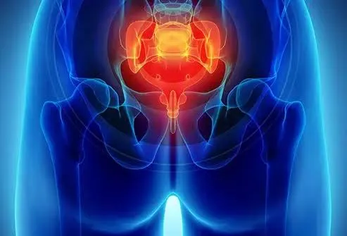 टेलबोन (Coccyx) दर्द में डोनट पिलो और वेज कुशन का सही इस्तेमाल
