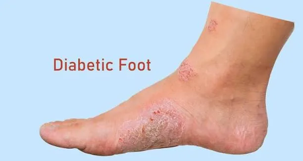 डायबिटिक फुट (Diabetic Foot) की देखभाल: मरीजों के लिए विशेष फुटवियर गाइड