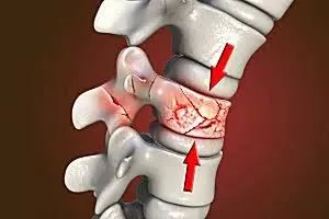डिहाइड्रेशन से स्पाइनल डिस्क (Intervertebral Discs) के लचीलेपन पर पड़ने वाला असर