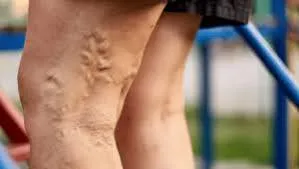 डीप वेन थ्रोम्बोसिस (DVT) से बचाव के लिए पोस्ट-सर्जरी एंकल पंपिंग (Ankle Pumping)