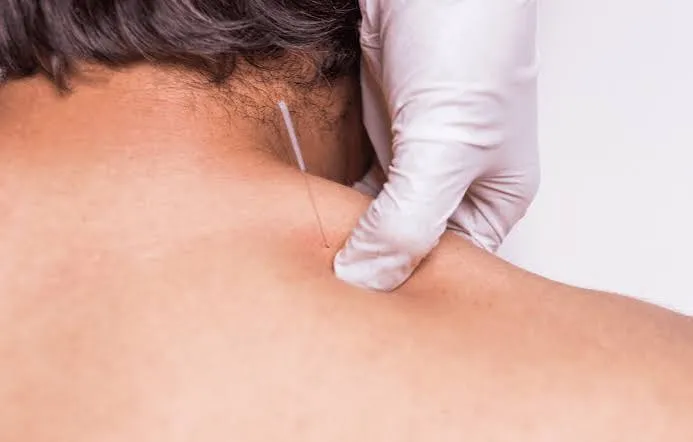 ड्राई नीडलिंग (Dry Needling) थेरेपी से क्रोनिक ट्रिगर पॉइंट्स को कैसे खोलें?