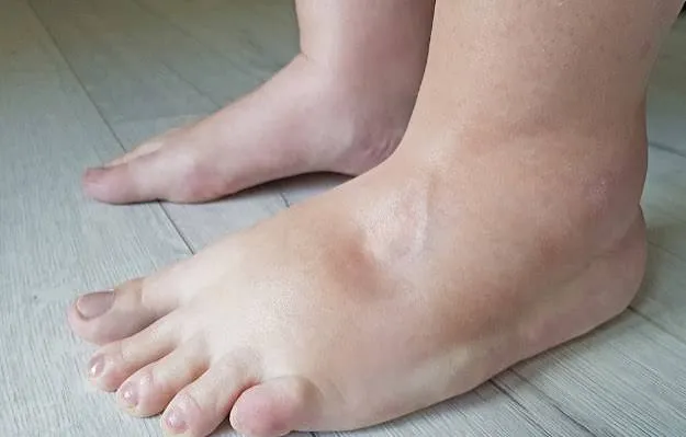 फ्लाइट अटेंडेंट्स के लिए जेट लैग और एड़ियों की सूजन (Ankle Edema) से राहत के उपाय