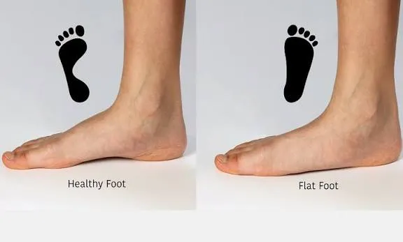 बच्चों में फ्लैट फुट (Flat Foot): कब यह सामान्य है और कब डॉक्टर को दिखाना चाहिए?