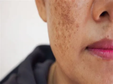 मेलाज्मा (Melasma / झाइयां)