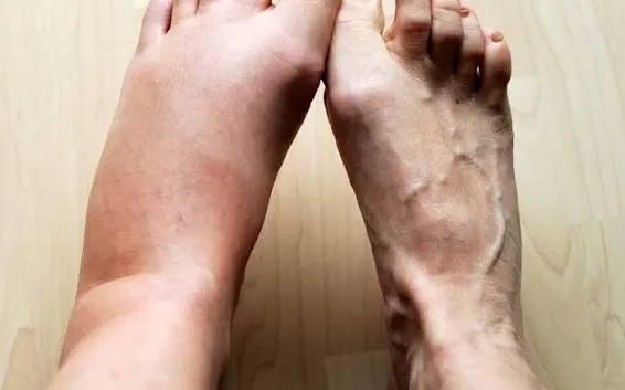 लिम्फेटिक ड्रेनेज मसाज (Lymphatic Drainage) से सूजन (Edema) कैसे कम करें?