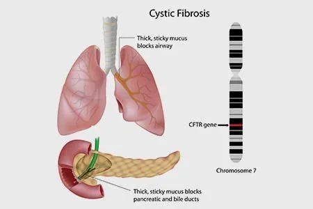 सिस्टिक फाइब्रोसिस (Cystic Fibrosis)