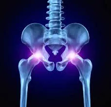 हिप रिप्लेसमेंट (Hip Replacement) के बाद सीढ़ियां चढ़ने और उतरने का सही तरीका