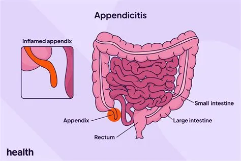 अपेंडिसाइटिस (Appendicitis)