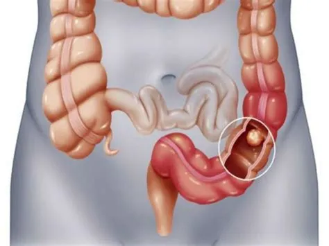 आंतों में रुकावट (Bowel Obstruction)