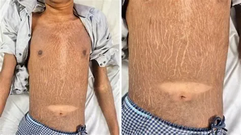 इचिथियोसिस (Ichthyosis - मछली की तरह सूखी त्वचा)
