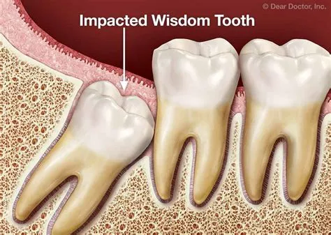 इम्पैक्टेड विजडम टूथ (Impacted Wisdom Tooth - अक्ल दाढ़ का फंसना)