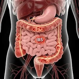 इर्रिटेबल बाउल सिंड्रोम (IBS)
