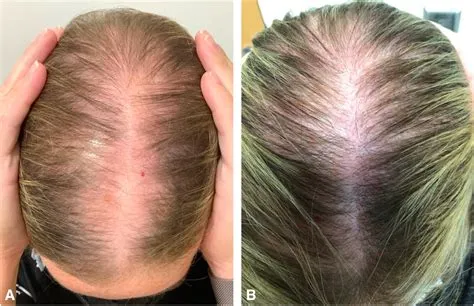 एंड्रोजेनेटिक एलोपेसिया (Androgenetic Alopecia - आनुवांशिक गंजापन)