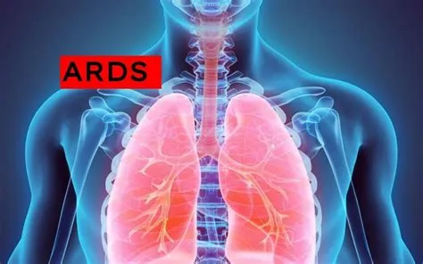 एआरडीएस (ARDS - एक्यूट रेस्पिरेटरी डिस्ट्रेस सिंड्रोम)