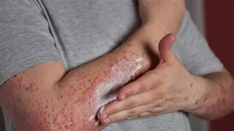 एक्जिमा (Eczema)