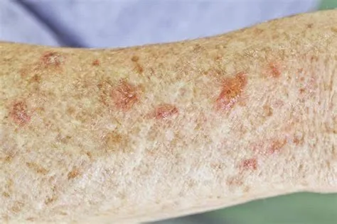 एक्टिनिक केराटोसिस (Actinic Keratosis)