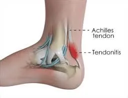 एड़ी के टेंडन (Achilles Tendon) की सर्जरी के बाद चलने (Gait) का सुरक्षित अभ्यास