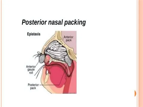 एपिस्टेक्सिस (Epistaxis - नकसीर फूटना)