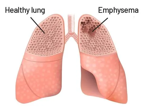 एम्फाइसेमा (Emphysema)