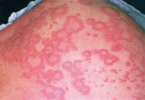 एरिथेमा मल्टीफॉर्म (Erythema Multiforme)