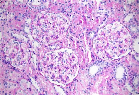 एल्पोर्ट सिंड्रोम (Alport Syndrome)