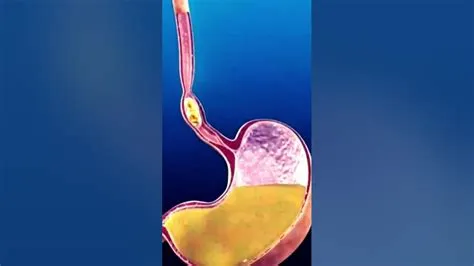 एसोफैजाइटिस (Esophagitis - भोजन नली की सूजन)