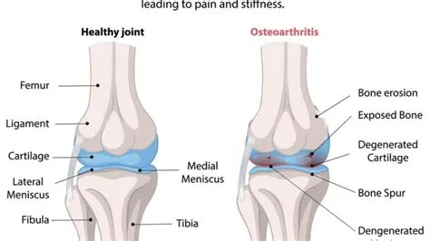 ऑस्टियोआर्थराइटिस (Osteoarthritis / घुटनों का घिसना)