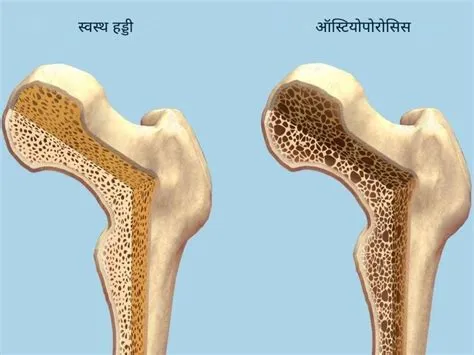 ऑस्टियोपोरोसिस (Osteoporosis / हड्डियों का खोखलापन)