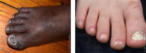 ओन्कोमाइकोसिस (Onychomycosis - नाखूनों का फंगल संक्रमण)
