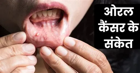 ओरल कैंसर (Oral Cancer मुंह का कैंसर)