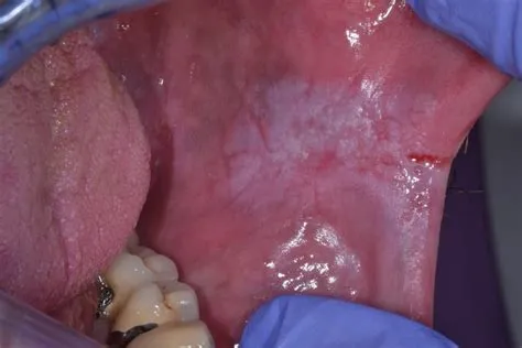 ओरल ल्यूकोप्लाकिया (Oral Leukoplakia - मुंह में सफेद धब्बे)
